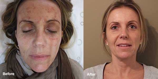 Skin peel and laser pigmentation treatment